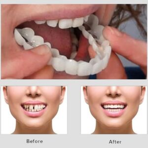 Snap On Smile - Veneers Teeth